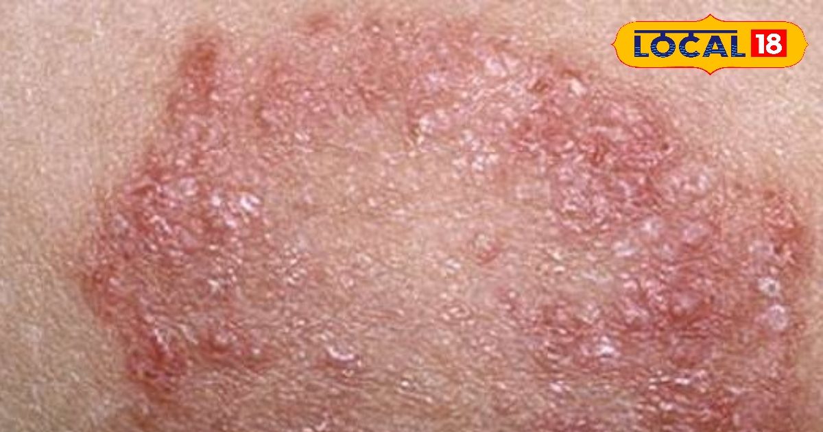 In the rainy season, the risk of ringworm and itching increases, know tips to prevent this